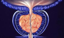 Prostat Büyümesi: Nedenleri, Belirtileri ve Tedavi Yöntemleri