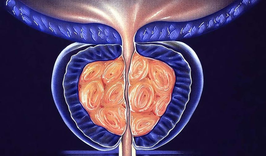 Prostat Büyümesi: Nedenleri, Belirtileri ve Tedavi Yöntemleri